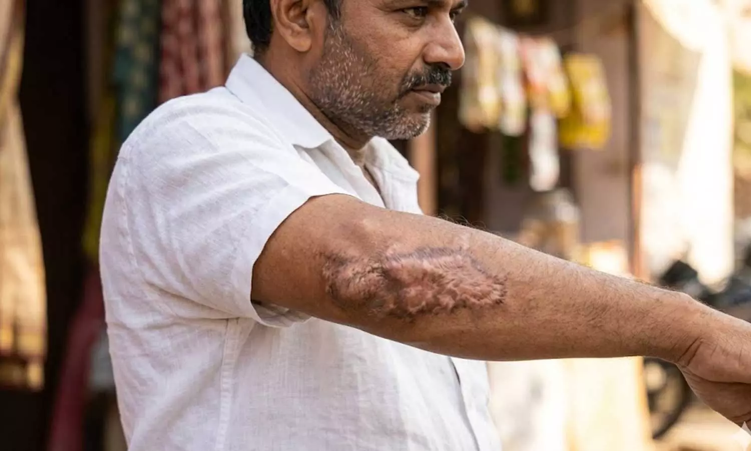 പഴയ പൊള്ളൽ പാടുകൾ കാൻസറായി മാറുമോ?; ഈ ലക്ഷണങ്ങള് അവഗണിക്കരുത് പഴയ പൊള്ളൽ പാടുകൾ കാൻസറായി മാറുമോ?; ഈ ലക്ഷണങ്ങള് അവഗണിക്കരുത്