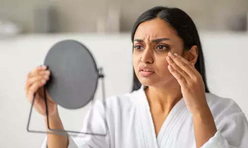 കണ്ണിന് താഴെ കറുപ്പ് പാടുണ്ടോ?; ഉറക്കമില്ലായ്മ മാത്രമല്ല വില്ലന്‍, യഥാര്‍ഥ കാരണങ്ങള്‍ അറിഞ്ഞിരിക്കണം