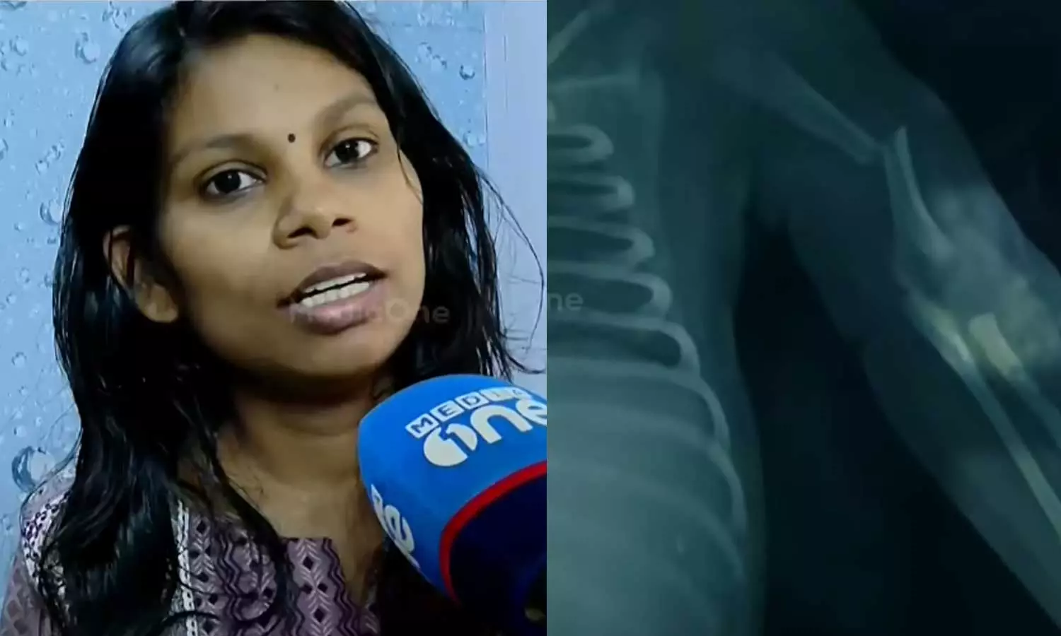 പ്രസവത്തിനിടെ നവജാത ശിശുവിന്റെ കൈ പൊട്ടി; കോഴിക്കോട് മെഡിക്കൽ കോളജിനെതിരെ ചികിത്സാ പിഴവ് ആരോപണം പ്രസവത്തിനിടെ നവജാത ശിശുവിന്റെ കൈ പൊട്ടി; കോഴിക്കോട് മെഡിക്കൽ കോളജിനെതിരെ ചികിത്സാ പിഴവ് ആരോപണം