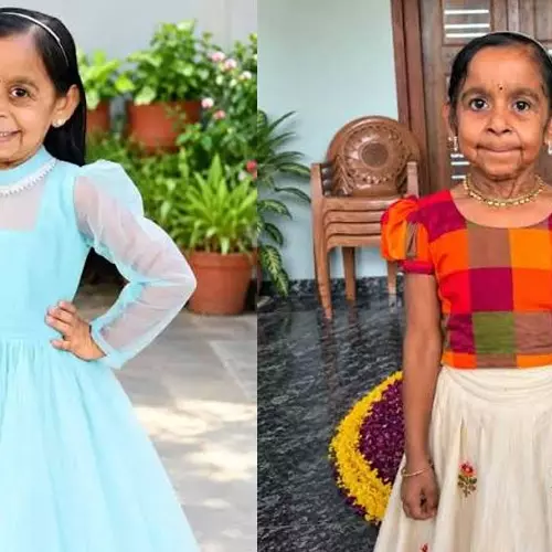 50 വർഷത്തിന് ശേഷം ആദ്യം; അപൂർവ രോഗാവസ്ഥയുമായി ആറുവയസ്സുകാരി തക്കു! എന്താണ് ക്യൂട്ടിസ് ലാക്സ?