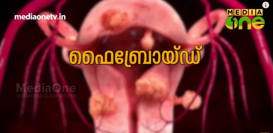 എന്താണ് ഫൈബ്രോയിഡ്? പേടിക്കേണ്ടതുണ്ടോ? എന്താണ് ഫൈബ്രോയിഡ്? പേടിക്കേണ്ടതുണ്ടോ?