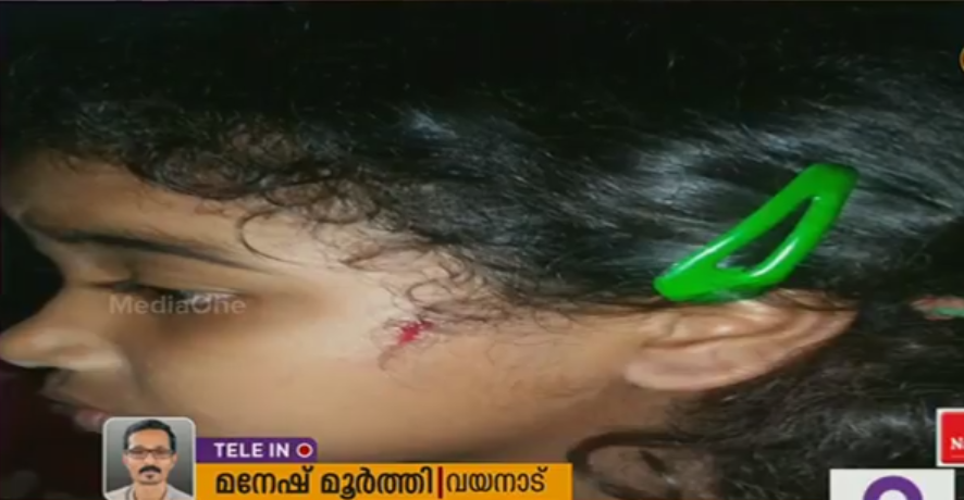 വയനാട്ടില്‍ തെരുവുനായയുടെ ആക്രമണത്തില്‍ എട്ടുവയസുകാരിക്ക് പരിക്ക്