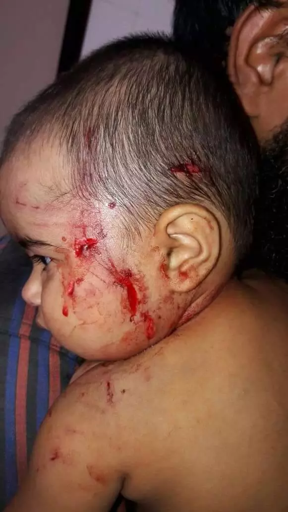 മലപ്പുറത്ത് പിഞ്ചുകുഞ്ഞിന് തെരുവുനായയുടെ കടിയേറ്റു മലപ്പുറത്ത് പിഞ്ചുകുഞ്ഞിന് തെരുവുനായയുടെ കടിയേറ്റു