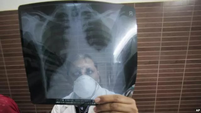 കുവൈത്തില് ജനസംഖ്യയുടെ 33 ശതമാനം പേര് ക്ഷയരോഗബാധിതരെന്ന് റിപ്പോര്ട്ട് കുവൈത്തില് ജനസംഖ്യയുടെ 33 ശതമാനം പേര് ക്ഷയരോഗബാധിതരെന്ന് റിപ്പോര്ട്ട്