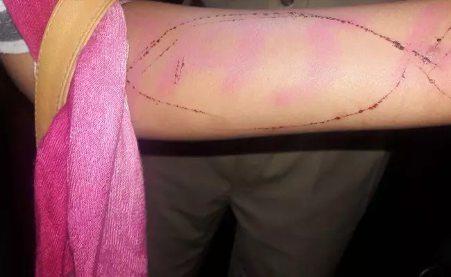 കയ്യില്‍ ബ്ലൂ വെയില്‍ വരഞ്ഞ് ആത്മഹത്യാശ്രമം നടത്തിയ പെണ്‍കുട്ടിയെ രക്ഷപ്പെടുത്തി