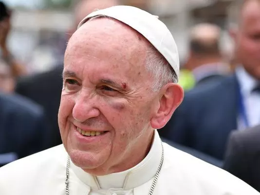 കൊളംബിയന് പര്യടനത്തിനിടെ ഫ്രാന്സിസ് മാര്പാപ്പക്ക് നിസാര പരിക്ക് കൊളംബിയന് പര്യടനത്തിനിടെ ഫ്രാന്സിസ് മാര്പാപ്പക്ക് നിസാര പരിക്ക്