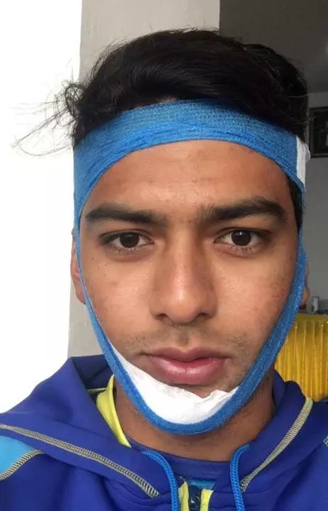 ഒടിഞ്ഞ താടിയെല്ലുമായി ബാറ്റ് ചെയ്ത ഉന്‍മുക്ത് നേടിയത് മിന്നും ശതകം