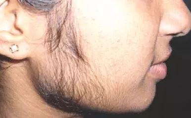 മുഖത്തെ രോമവളര്‍ച്ച അലട്ടുന്നുവോ; പരിഹാരമുണ്ട്