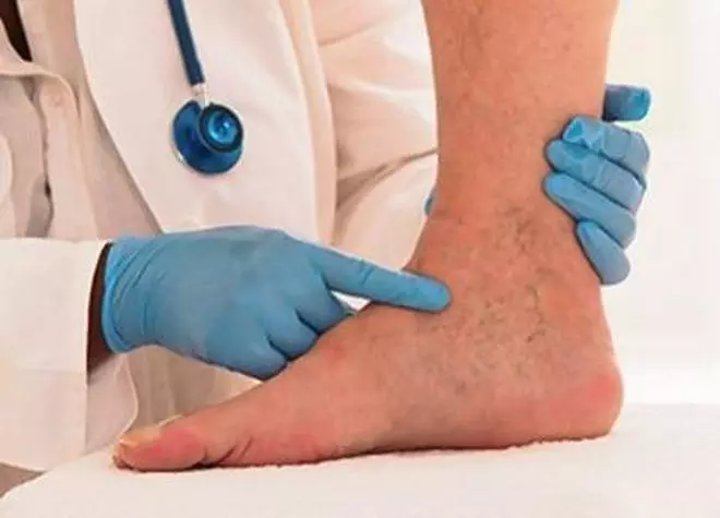 ഉയരമുള്ളവര്‍ക്ക് വെരിക്കോസ് വെയിന്‍ വരാന്‍ സാധ്യത കൂടുതലെന്ന് പഠനം