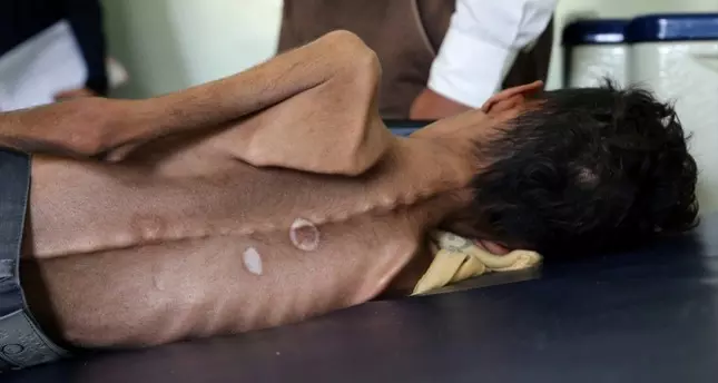 യമനില് ഏഴ് മില്യണിലധികം കുട്ടികള് ഗുരുതര പട്ടിണിയിലെന്ന് യു.എന് മുന്നറിയിപ്പ് യമനില് ഏഴ് മില്യണിലധികം കുട്ടികള് ഗുരുതര പട്ടിണിയിലെന്ന് യു.എന് മുന്നറിയിപ്പ്