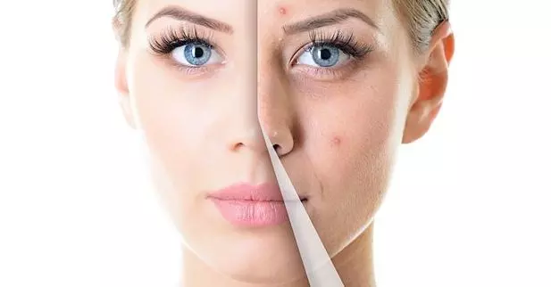 മുഖക്കുരു- കാരണങ്ങളും പരിഹാരമാര്ഗങ്ങളും മുഖക്കുരു- കാരണങ്ങളും പരിഹാരമാര്ഗങ്ങളും