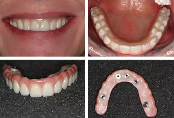 കൃത്രിമ പല്ല് വയ്ക്കാന് പോവാണോ? എങ്കില് ഇതൊക്കെ അറിഞ്ഞോളൂ.. കൃത്രിമ പല്ല് വയ്ക്കാന് പോവാണോ? എങ്കില് ഇതൊക്കെ അറിഞ്ഞോളൂ..