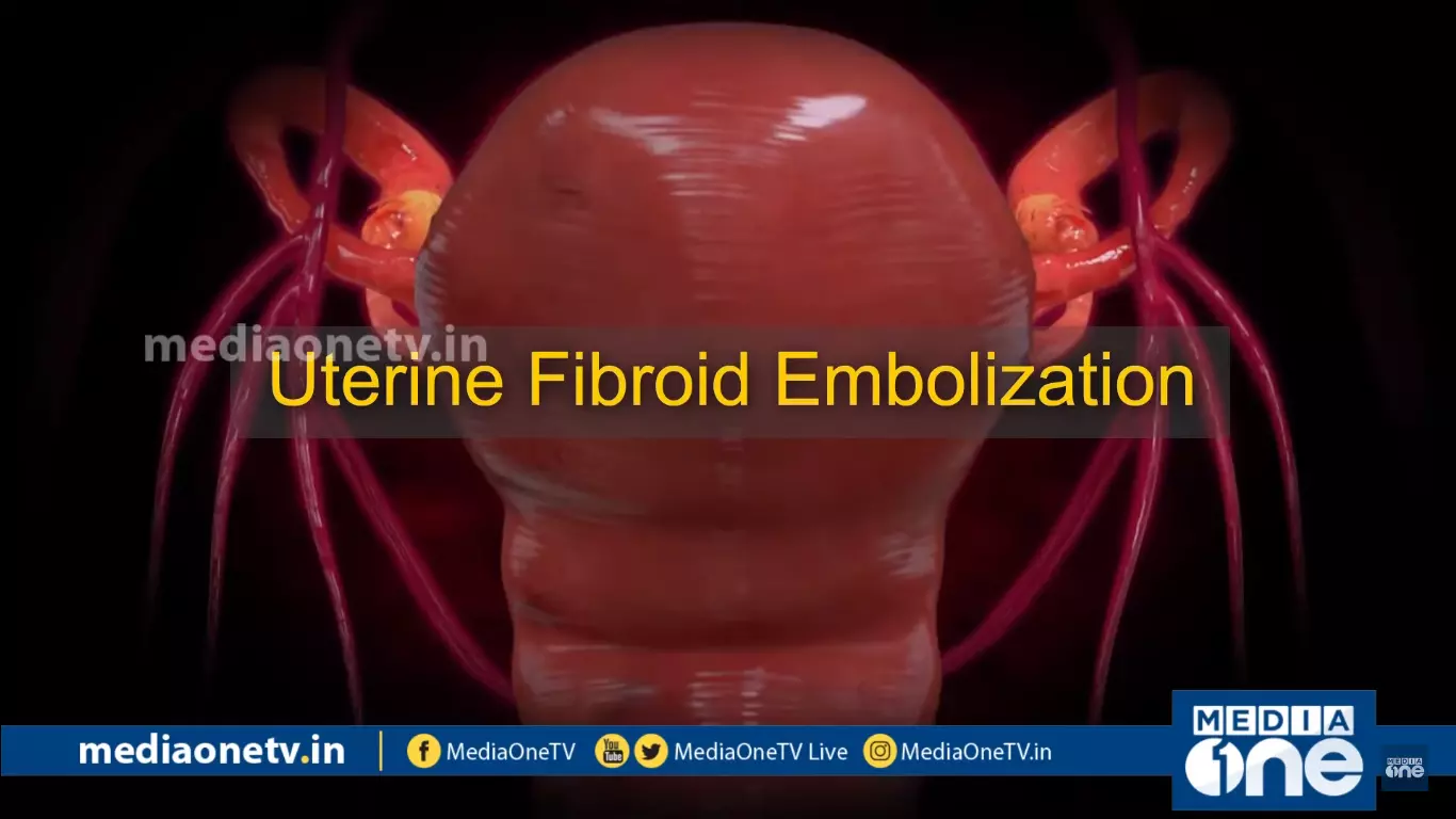 Uterine Fibroid Embolization |Stethoscope