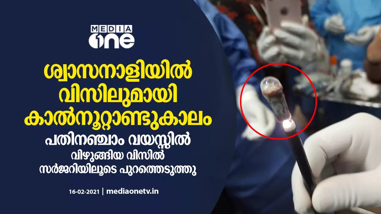 ശ്വാസനാളിയിൽ കുടുങ്ങിയ വിസിലുമായി കഴിഞ്ഞത് കാല്നൂറ്റാണ്ടുകാലം ശ്വാസനാളിയിൽ കുടുങ്ങിയ വിസിലുമായി കഴിഞ്ഞത് കാല്നൂറ്റാണ്ടുകാലം
