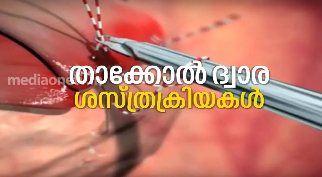 താക്കോല്‍ ദ്വാര ശസ്ത്രക്രിയകള്‍