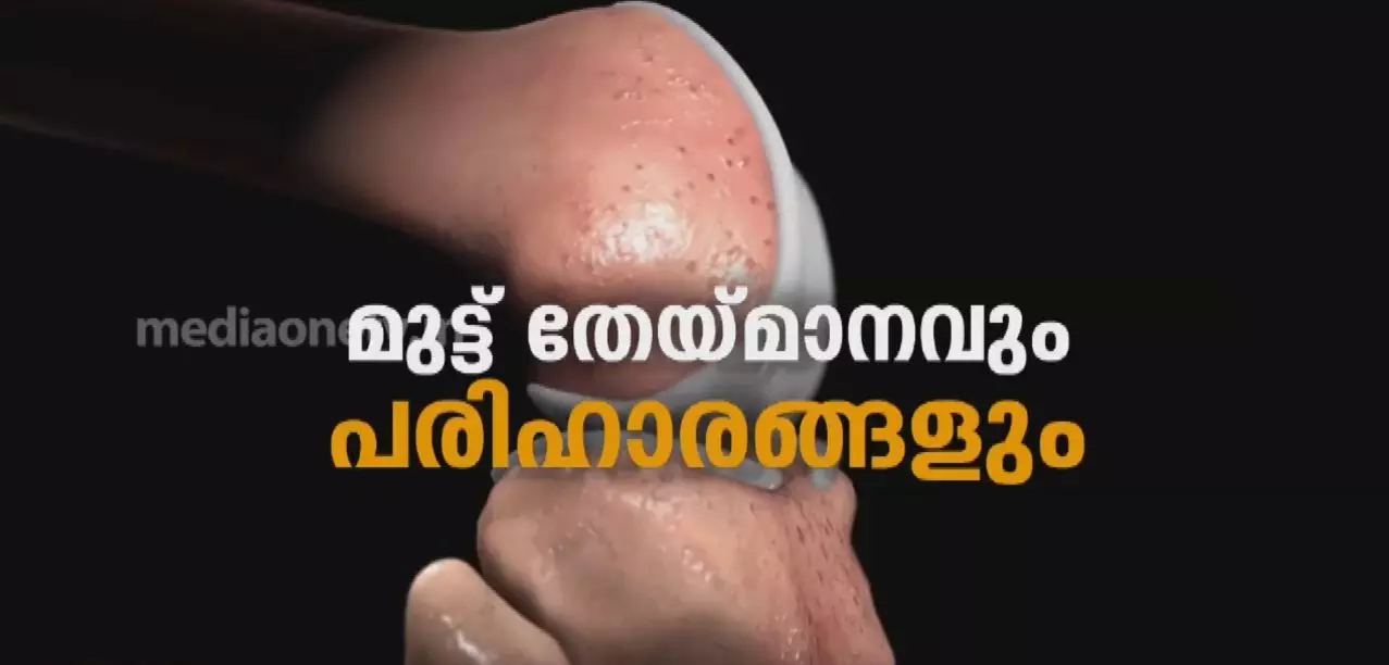 മുട്ട് തേയ്മാനവും പരിഹാരങ്ങളും 