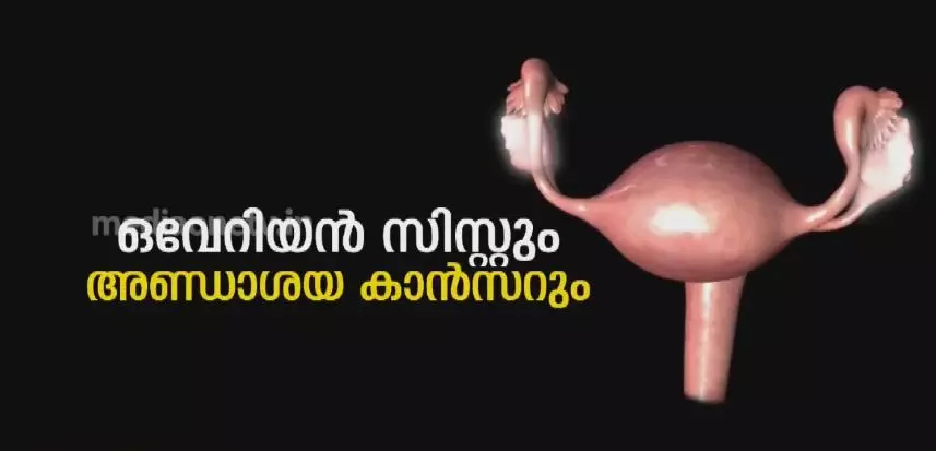 ഒവേറിയൻ സിസ്റ്റും അണ്ഡാശയ ക്യാൻസറും 