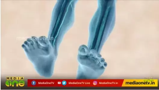 കാലിൽ കറുത്ത നിറമോ ഉണങ്ങാത്ത മുറിവോ ഉണ്ടോ? സൂക്ഷിക്കണം 