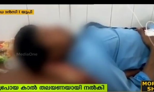 അറ്റുപോയ കാല് തലയണയായി നല്കി ആശുപത്രി അധികൃതരുടെ ക്രൂരത അറ്റുപോയ കാല് തലയണയായി നല്കി ആശുപത്രി അധികൃതരുടെ ക്രൂരത