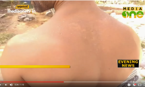 വയനാട് ജില്ലയില്‍ രണ്ട് പേര്‍ക്ക് സൂര്യതാപമേറ്റു