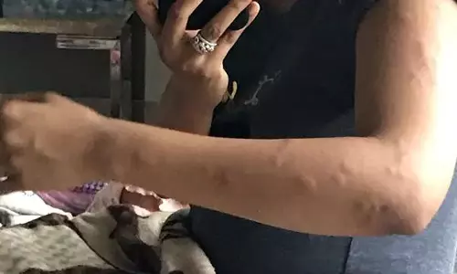 എയര് ഇന്ത്യയുടെ ബിസിനസ് ക്ലാസിലും മൂട്ടകടി എയര് ഇന്ത്യയുടെ ബിസിനസ് ക്ലാസിലും മൂട്ടകടി