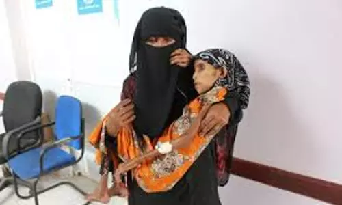 ഫാത്തിമ ഖോബ,  വയസ്സ് 12, ശരീരഭാരം വെറും 10 കിലോ: യമന്‍ യുദ്ധത്തിന്റെ ജീവിച്ചിരിക്കുന്ന രക്തസാക്ഷികളിലൊരാള്‍