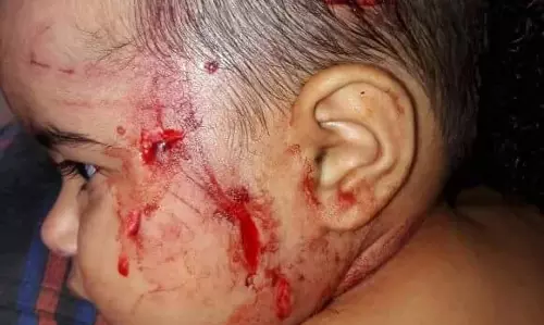 മലപ്പുറത്ത് പിഞ്ചുകുഞ്ഞിന് തെരുവുനായയുടെ കടിയേറ്റു