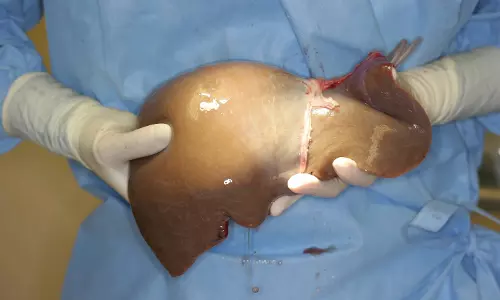 സംസ്ഥാനത്ത് ആദ്യമായി സര്ക്കാര് ആശുപത്രിയില് കരള് മാറ്റിവയ്ക്കല് ശസ്ത്രക്രിയ നടന്നു സംസ്ഥാനത്ത് ആദ്യമായി സര്ക്കാര് ആശുപത്രിയില് കരള് മാറ്റിവയ്ക്കല് ശസ്ത്രക്രിയ നടന്നു