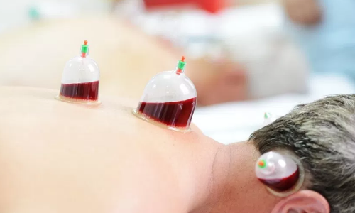 ഹിജാമ ചികിത്സാ രീതി:  സത്യമെന്ത്?  