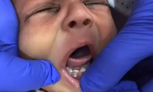 പൂര്‍ണ്ണവളര്‍ച്ചയെത്തിയ പല്ലുകളുമായി ഒരു പിഞ്ചുകുഞ്ഞ്