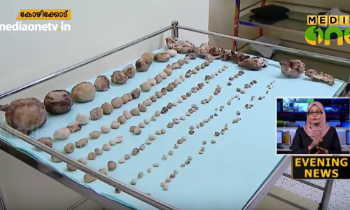 ഒമാന്‍ യുവതിയുടെ ഗര്‍ഭപാത്രത്തില്‍നിന്നും 191 മുഴകള്‍ പുറത്തെടുത്തു