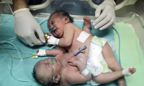 13 മണിക്കൂര്‍ നീണ്ട ശസ്ത്രക്രിയക്കൊടുവില്‍ അവര്‍ രണ്ടായി,പക്ഷേ ഒരാളുടെ ജീവന്‍ വിധി തട്ടിയെടുത്തു