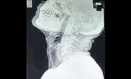 ശരീരത്തിനുള്ളില്‍ 75 മൊട്ടുസൂചികളുമായി ജീവിക്കുന്ന മനുഷ്യന്‍