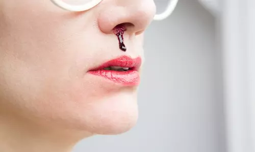 മൂക്കില്‍ നിന്നുള്ള രക്തം വരവിനെ ബ്ലഡ് കാന്‍സറായി തെറ്റിദ്ധരിക്കേണ്ട