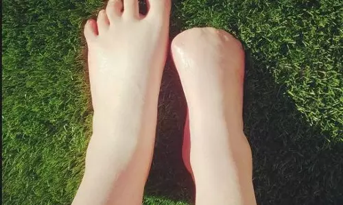 ഫിഷ് സ്പാ ചെയ്ത യുവതിക്ക് കാല്‍വിരലുകള്‍ നഷ്ടമായതിങ്ങനെ...