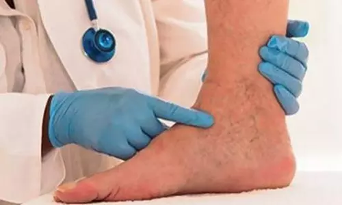 ഉയരമുള്ളവര്‍ക്ക് വെരിക്കോസ് വെയിന്‍ വരാന്‍ സാധ്യത കൂടുതലെന്ന് പഠനം