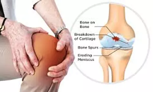 മുട്ടുവേദന തടയാം | Osteoarthritis Epi 23