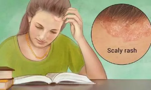 സോറിയാസിസ് ചികിത്സ എങ്ങിനെ? | Psoriasis Epi 32 സോറിയാസിസ് ചികിത്സ എങ്ങിനെ? | Psoriasis Epi 32