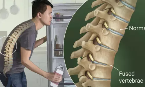 ആര്യവൈദ്യന് | Ankylosing Spondylitis Epi 26 ആര്യവൈദ്യന് | Ankylosing Spondylitis Epi 26