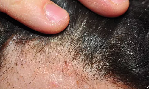 സൊറിയാസിസ് | Psoriasis | Epi 29 സൊറിയാസിസ് | Psoriasis | Epi 29