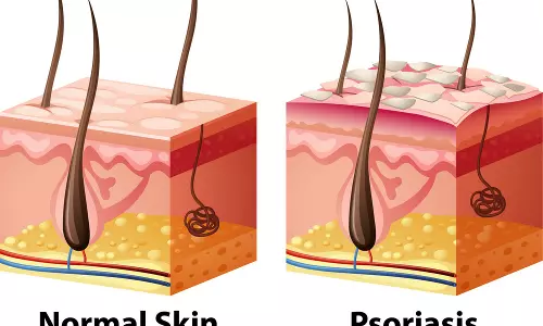 സൊറിയാസിസ് എങ്ങനെ ഉണ്ടാകുന്നു? Epi 30 സൊറിയാസിസ് എങ്ങനെ ഉണ്ടാകുന്നു? Epi 30