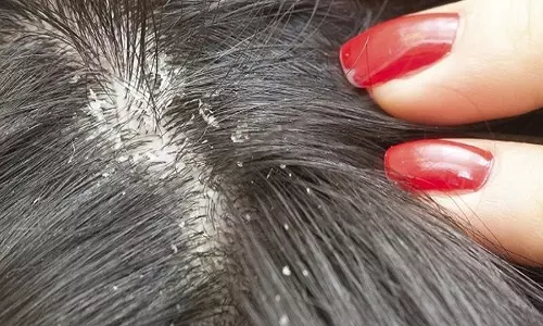 താരനെന്ന പേടിസ്വപ്നത്തെ ഓടിക്കാം