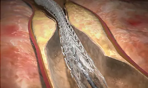 ആന്‍ജിയോപ്ലാസ്റ്റിയിലെ സാധ്യതകൾ | Angioplasty 