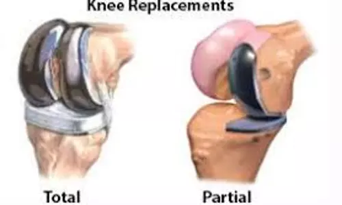 കാൽമുട്ട് മാറ്റിവെക്കൽ ശസ്ത്രക്രിയ