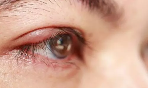 കണ്ണില്‍ കുരുവുണ്ടായാല്‍..