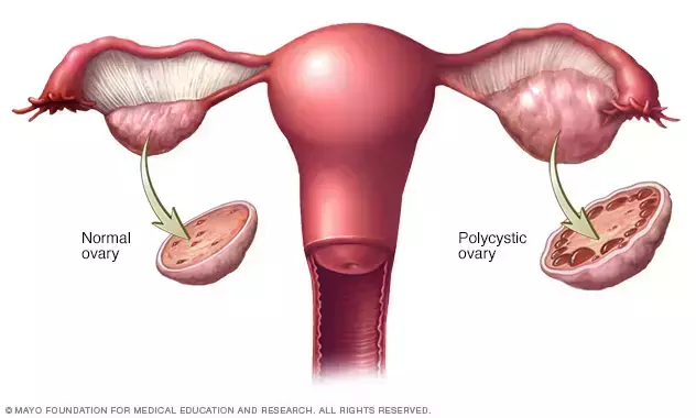 Polycystic ovary syndrome | Ayurveda Polycystic ovary syndrome | Ayurveda