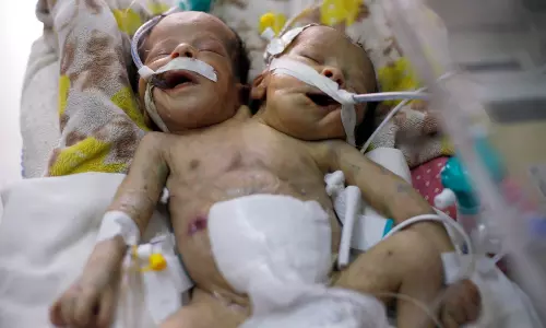 യുദ്ധം തകര്‍ത്ത യമനിൽ വേണ്ടത്ര ചികിത്സ ലഭിക്കാതെ സയാമീസ് ഇരട്ടകൾ മരിച്ചു