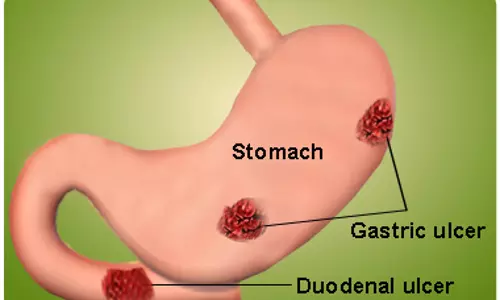 അസിഡിറ്റിയും അൾസർ രോഗങ്ങളും | Acidity And Ulcer Diseases 