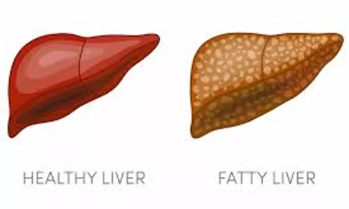 ഫാറ്റിലിവര്‍ തടയാം 
