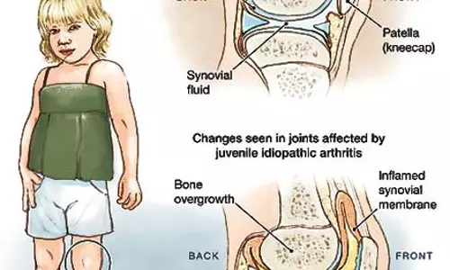 കുട്ടികളിലെ ആർത്രൈറ്റിസ് | Arthritis In Kids 